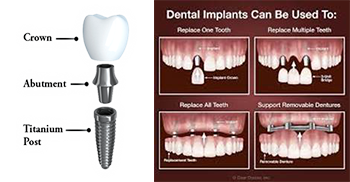 dental implant graphics